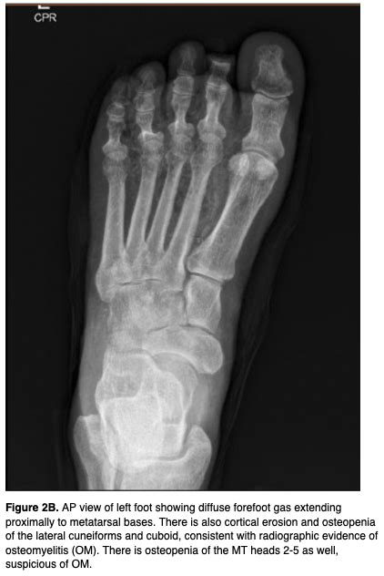 Chopart Amputation, a Viable Alternative for Non-Ambulatory Patients | Podiatry Today