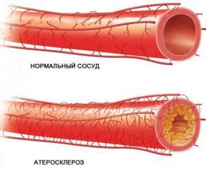 Blood chylesis: concept, causes of lipemia, manifestations, dangers, treatment