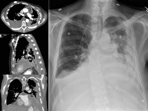 How Does Mesothelioma Differ from Other Lung Cancers?