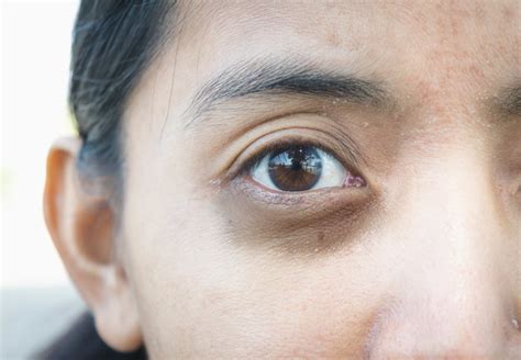 Dark Circles Under the Eyes- Why We Have Them and How To Treat Them - Chrysalis Clinic | Ottawa ...