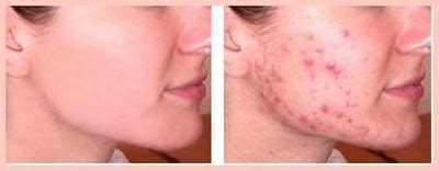 How I Cured My Cystic Acne In 30 Days