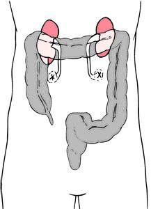 Ureterostomy Stent