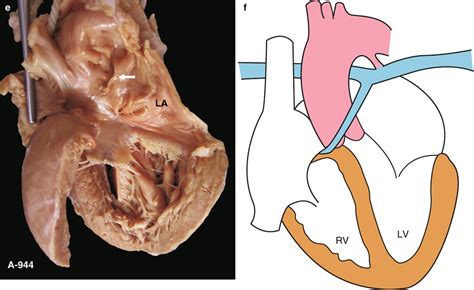 Pulmonary Atresia | Thoracic Key