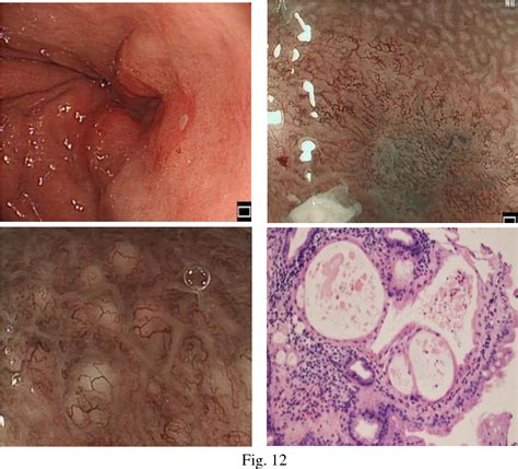 Diagnosis of Helicobacter pylori-related chronic gastritis, gastric adenoma and early gastric ...