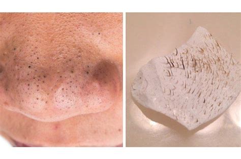 Here's What You Should Know Before Using Pore Strips #ShrinkPores # ...