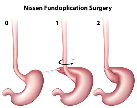 Fundoplication Specialist - Dallas, Plano, & Tyler, TX: Center for ...