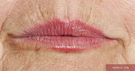 Causes Of Upper Lip Wrinkles and Best Treatments