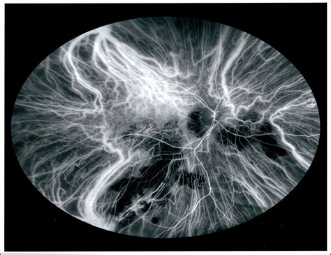 Serpiginous Choroiditis | ASCRS