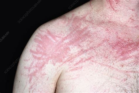 Dermatographic urticaria - Stock Image - C028/4401 - Science Photo Library