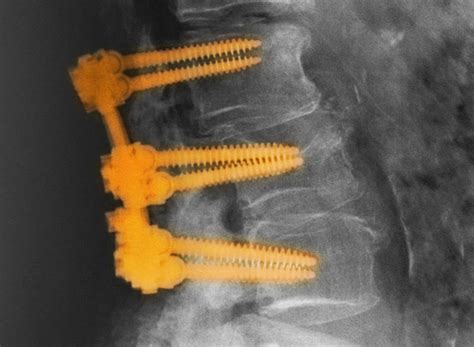 Bone Quality Linked to Complications After Spinal Fusion ...