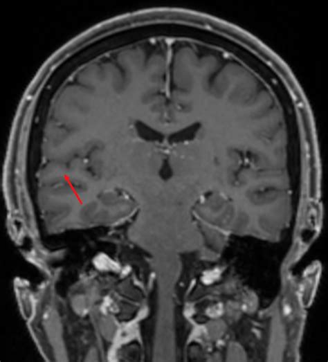 Gyrus temporalis superior - Ars Neurochirurgica