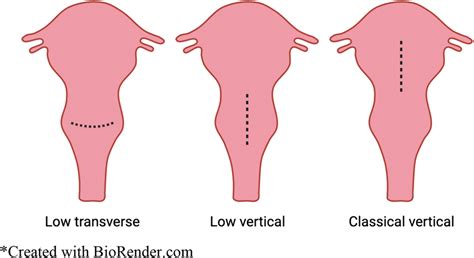 Cesarean Scar