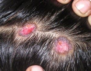 Teledermatology for PG entrance: Discoid lupus erythematosus