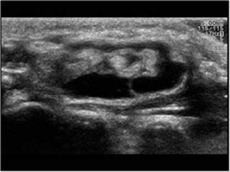 Flexor Tendons Wrist Ultrasound