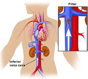 IVC Filter - Varicose veins | Vascular surgeon | Stroke | DVT | Leg gangrene | Cancer