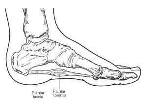 Seattle Plantar Fibroma Doctor - Seattle Foot and Ankle Center