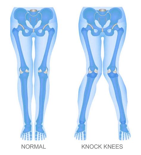 Distal Femoral Osteotomy | Knocked Knee Surgery | Minnesota