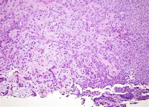 Desmoplastic Trichilemmoma | Dermatopathology