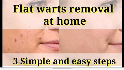 Flat warts removal at home / 3 easy steps - YouTube