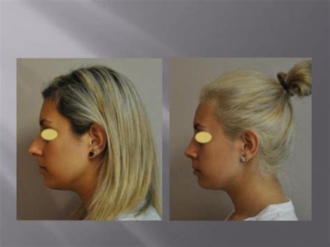 Patient Gallery | New York Rhinoplasty