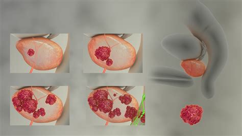 Prostate Cancer: Symptoms, Causes, and Treatment - Scientific animations