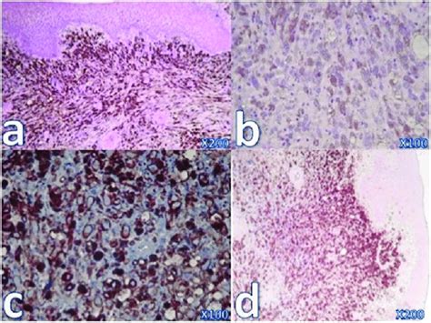 Histopathology and immunohistochemistry staining analyses of malignant ...