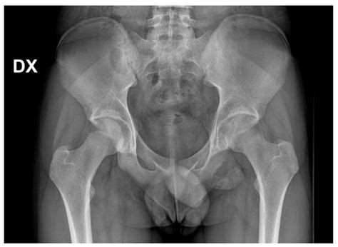 Trauma Care | Free Full-Text | Current Concepts in Pediatric Pelvic Ring Fractures: A Narrative ...