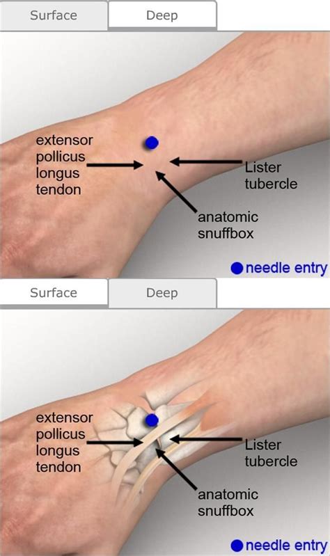 lister's tubercle - | Hand therapy, Massage therapy, Trigger point therapy