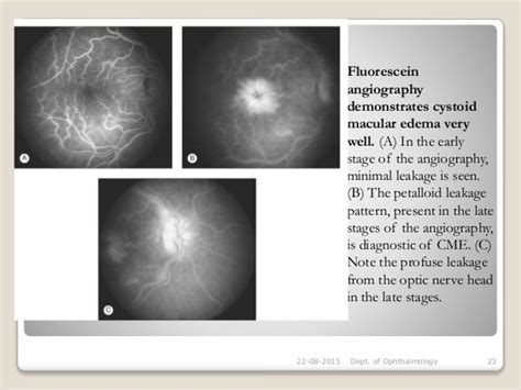 Cystoid macular oedema