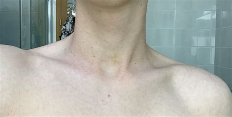 What is this yellow spot on my lower neck ? : r/DermatologyQuestions