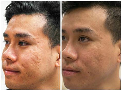 How PRP Injection Solves Facial Acne Scar In Selangor & KL | Malaysia || PRP Malaysia 自体细胞回春术