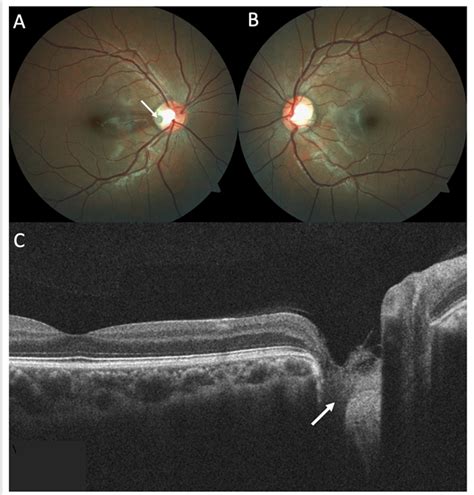 Optic Disc Pit - Retina Image Bank