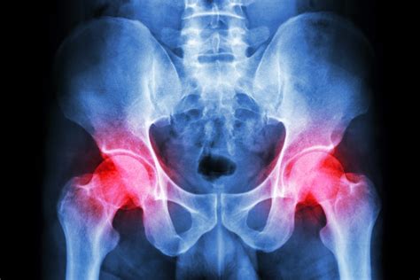 Hip Bursitis | Symptoms and Treatment Plans | OrthoIndy Blog