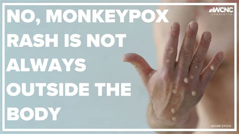 Monkeypox rashes are not always outside the body | wcnc.com