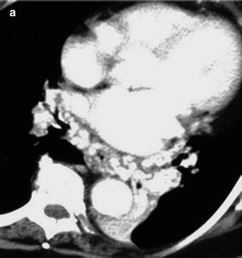 Massive Hemoptysis: Radiological Management | Thoracic Key