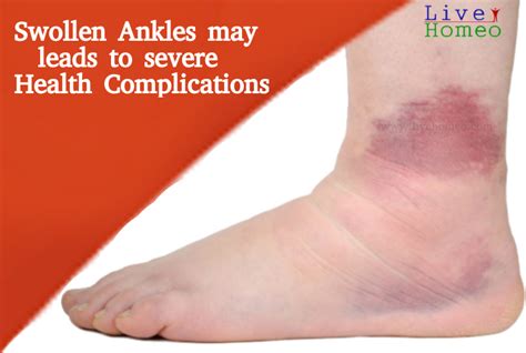 Best Homeopathy to control your Swollen Ankles problem – Live Homeo ...