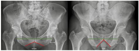 JCM | Free Full-Text | The Female Pelvis Is Associated with a ...