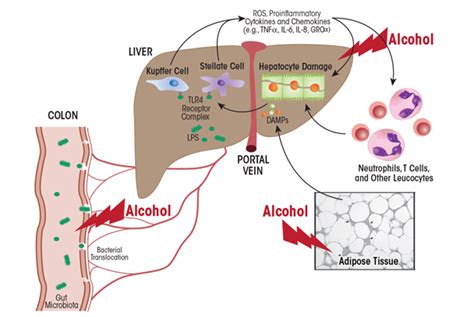 Alcoholic Liver Disease: Pathogenesis and Current Management | Alcohol ...