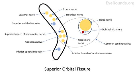 File:EyeRounds Case 355, Superior-Orbital-Fissure-Syndrome model.png - NC Commons