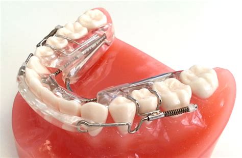 Fast Orthodontic Treatment – How An Inman Aligner Can Help | Blog