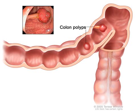 Colorectal Cancer Diagnosis and Treatment | Knight Cancer Institute | OHSU