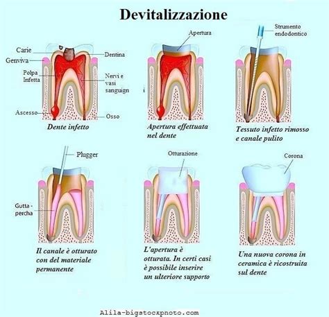 Dente devitalizzato e devitalizzazione per un ascesso