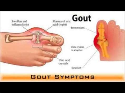 Medication for Gout - Some Cures For Gout. - YouTube