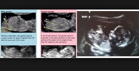 Gender reveal at 12 week scan. - July 2015 - BabyCenter Australia