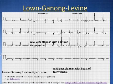 Ecg basic guidelines