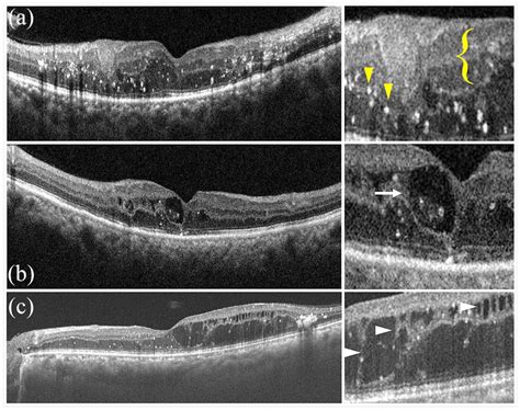 Macular Edema Oct