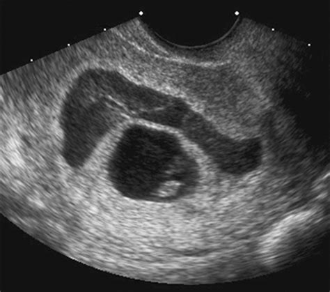 Prognosis of Very Large First‐Trimester Hematomas - Leite - 2006 ...