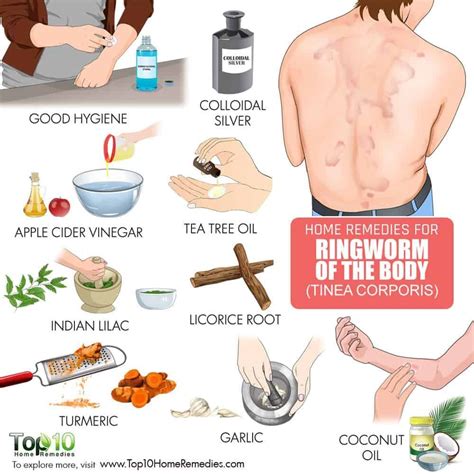 How to Get Rid of Ringworm (of the Body) #homeremediesforringworm (With images) | Ringworm ...