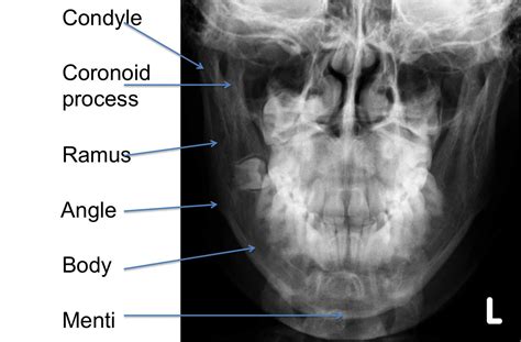 The Facial Bones