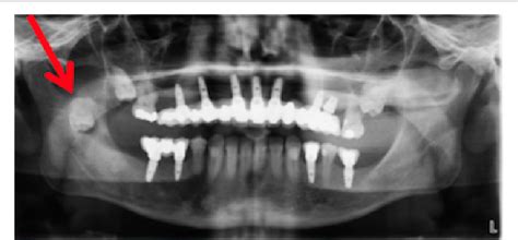 Figure 2 from An Infected Ectopic Wisdom Tooth in the Ascending Ramus | Semantic Scholar